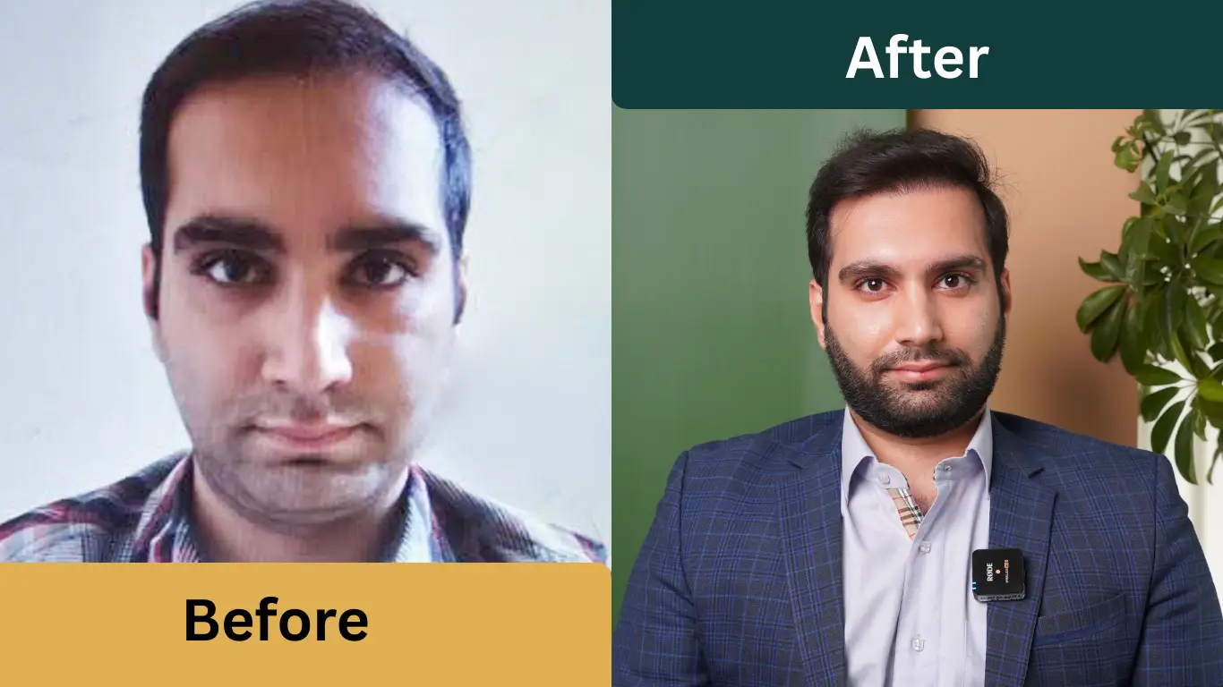 قبل و بعد از کاشت مو