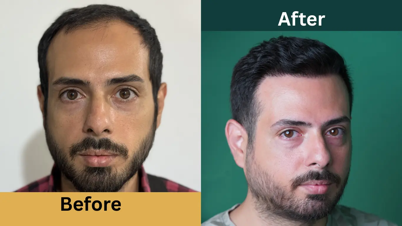 قبل و بعد از کاشت مو