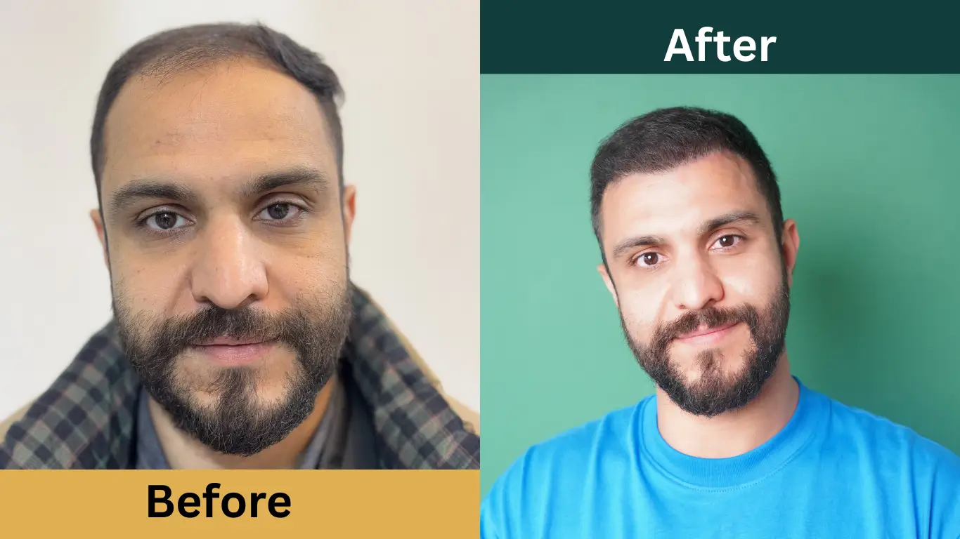 قبل و بعد از کاشت مو