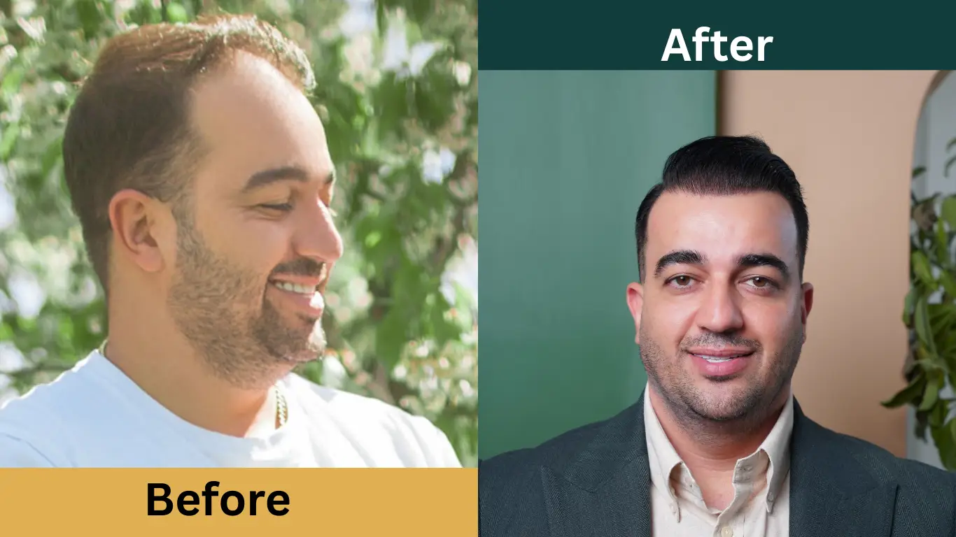 قبل و بعد از کاشت مو