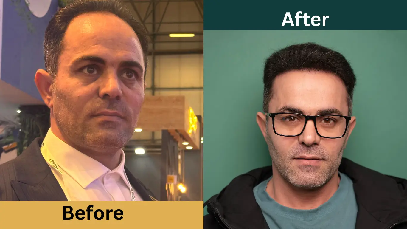 قبل و بعد از کاشت مو