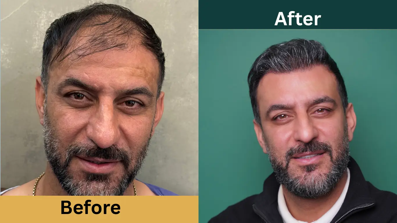 قبل و بعد از کاشت مو هادی شکوری