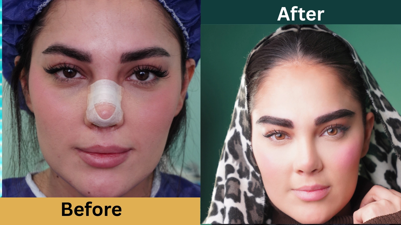 قبل و بعد از کاشت ابرو