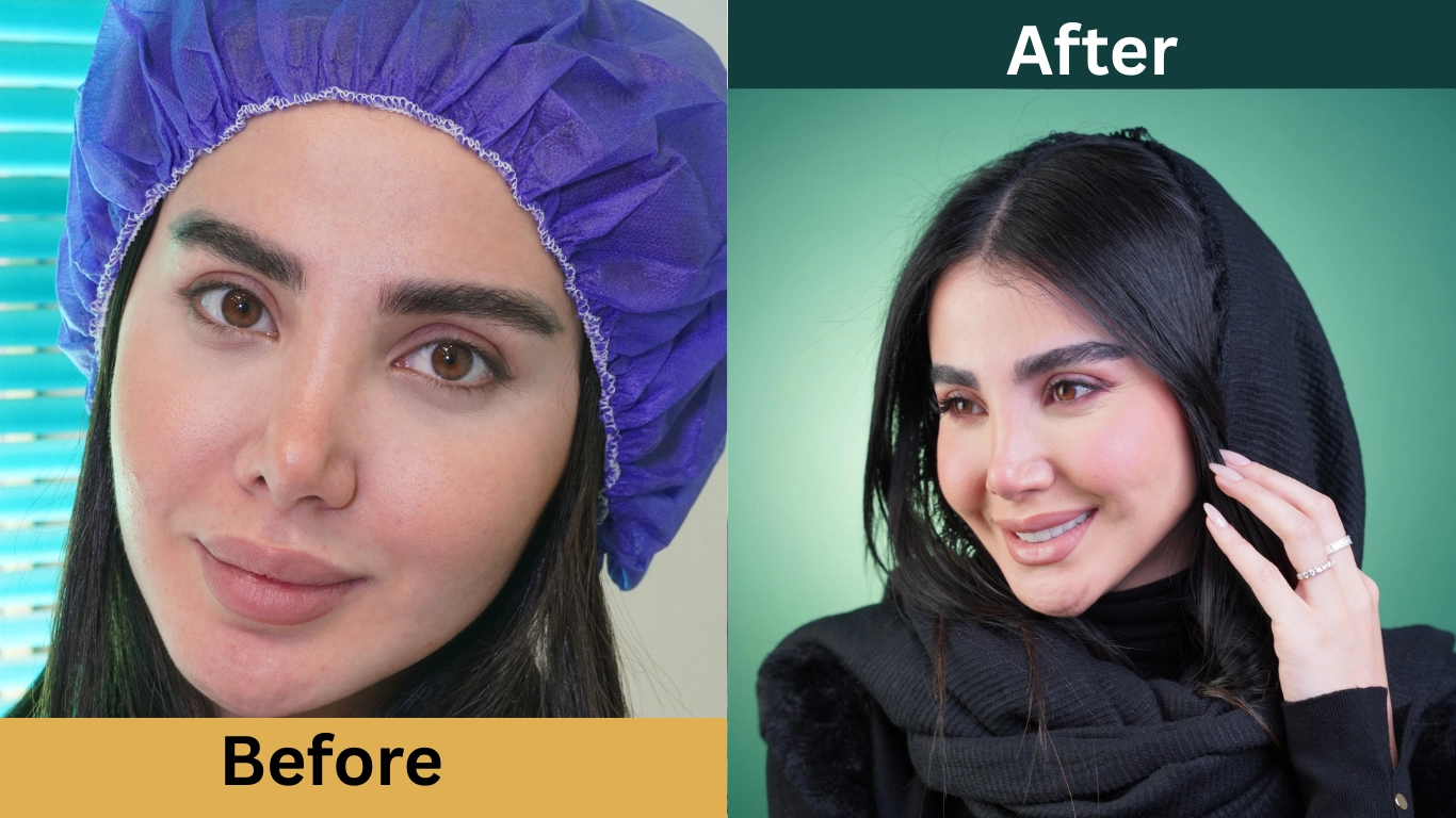 قبل و بعد از کاشت ابرو