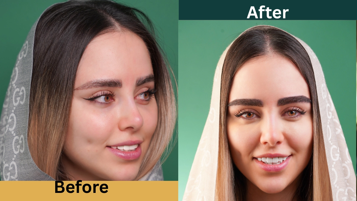 قبل و بعد از کاشت ابرو