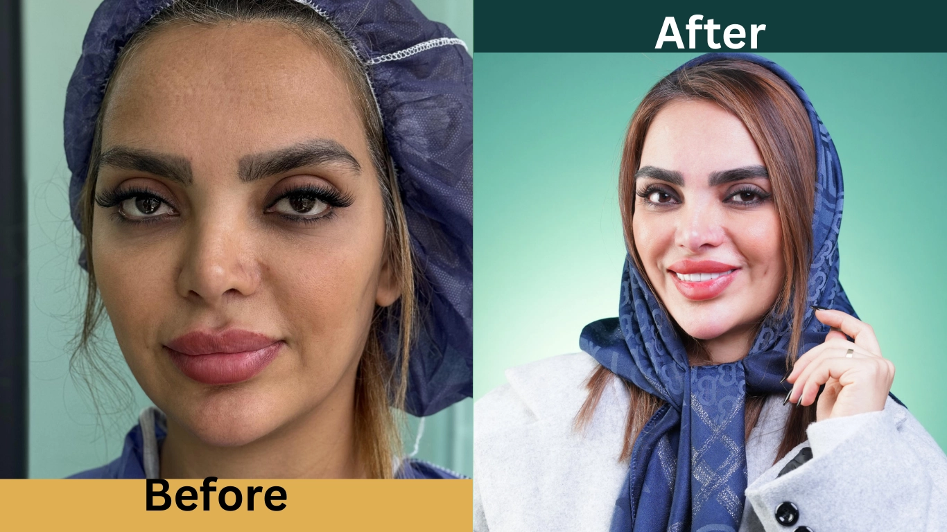 قبل و بعد از کاشت ابرو