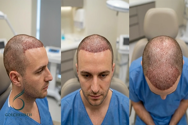 جامع ترین راهنمای انواع روش های کاشت مو