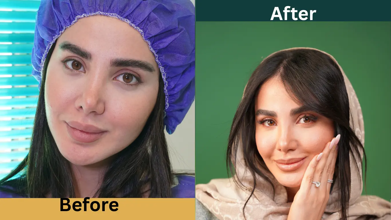 قبل و بعد از کاشت ابرو