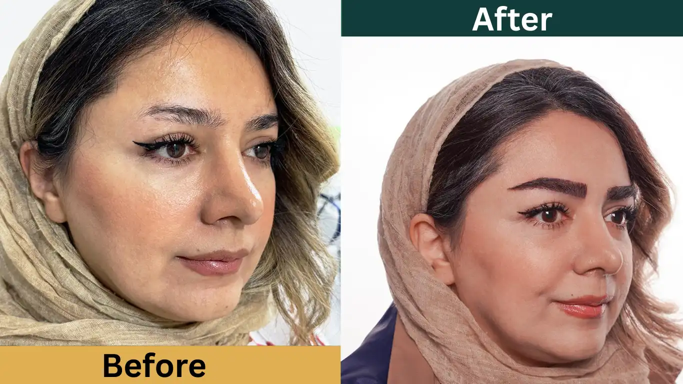 عکس قبل و بعد از کاشت ابرو