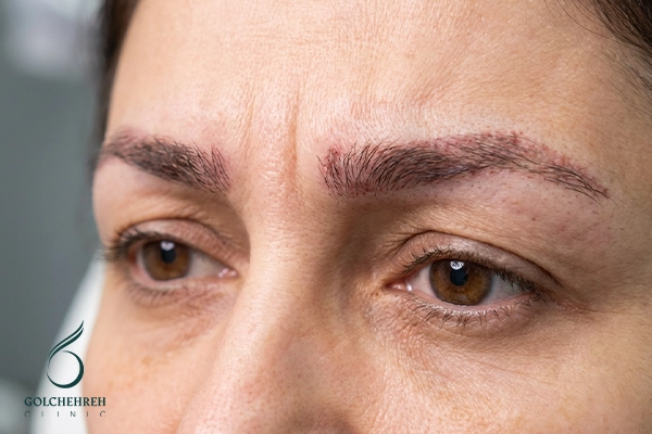 پشیمانی بعد از کاشت ابرو: چرا برخی افراد ناراضی هستند؟